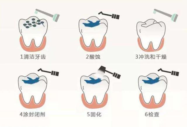 胶东在线|为什么说窝沟封闭是预防儿童蛀牙的最有效方法?
