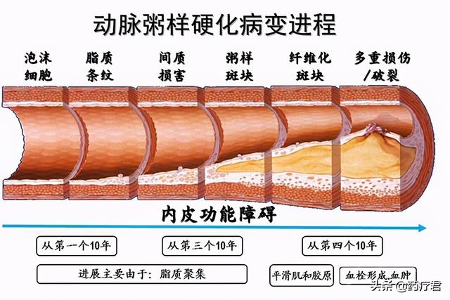 睡前喝水，能稀释血液防心梗？医生推荐的“化血栓”运动了解下