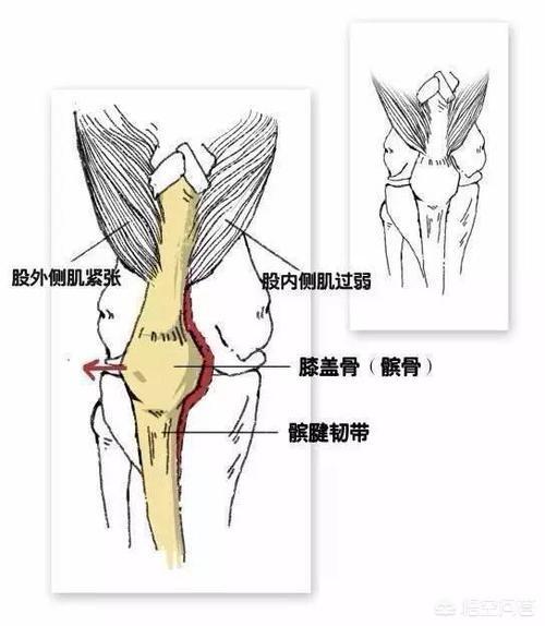 内侧半月板|为什么走平路膝关节不疼，但是打弯、下楼梯、蹲起时膝关节疼痛呢