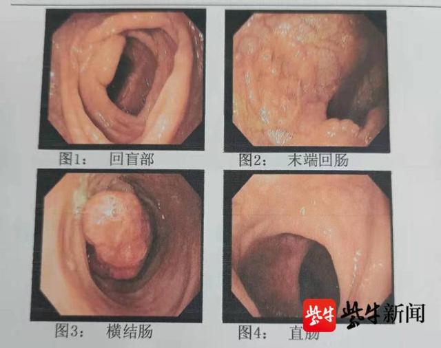 息肉|息肉作怪，4岁男童反复便血，专家合力为其“拆弹”