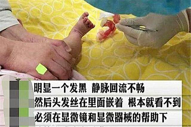 超级宝妈■6个月娃脚趾进“虫”，吓得宝妈赶紧带娃去医院，医生：还好及时