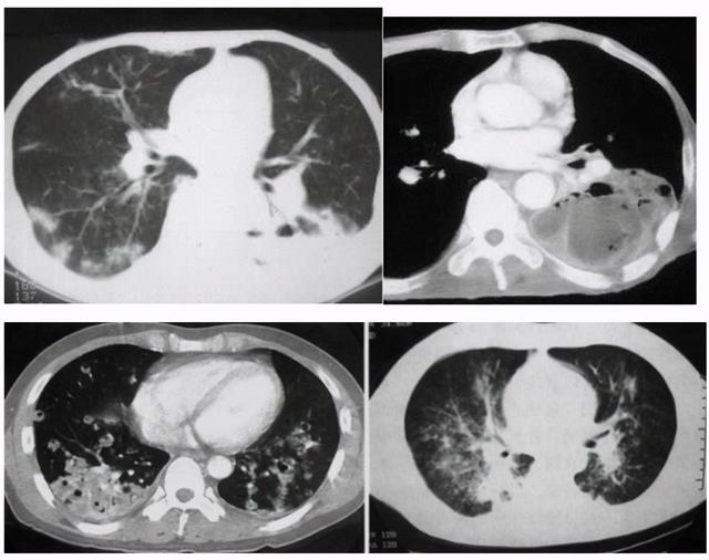 17句话，总结肺部感染的影像变现