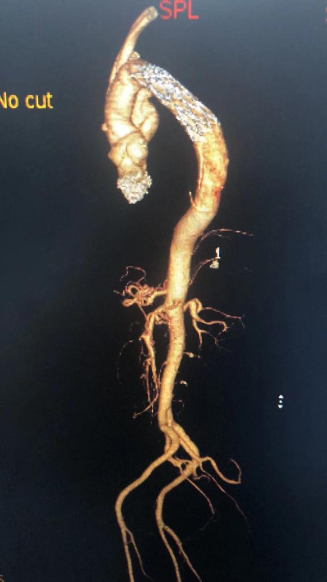 心血管刚修不久又漏了，扬州王强团队“二次修心”还患者健康