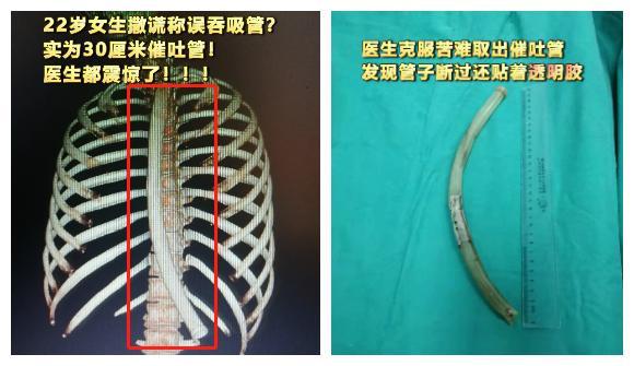 为了减肥，将催吐管插入胃里50CM……这些减肥方法危害想过吗？