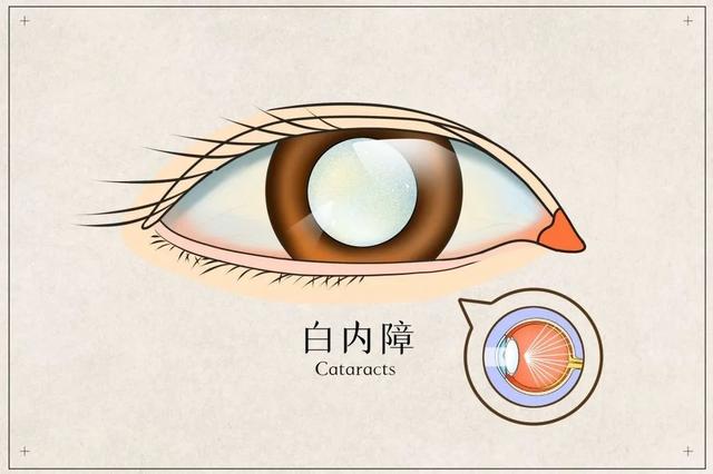 专家在线｜老年白内障的治疗——青岛市第八人民医院眼科主任张国文