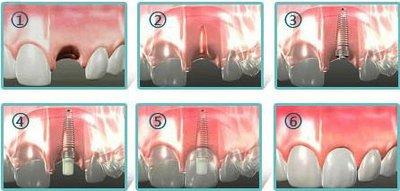 到底什么是种植牙，手术的过程是什么样的？真的值得做吗？