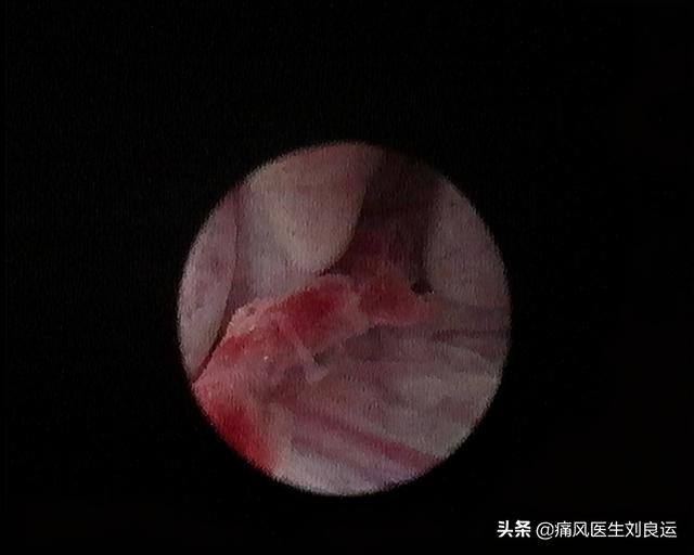 男人易痛风，女人易患类风湿？治疗关节疼痛别“走错门”需对症