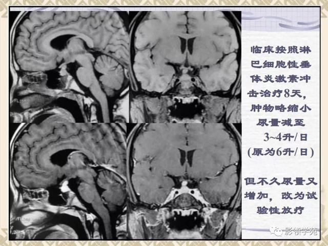 垂体病变的MRI诊断