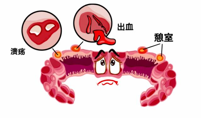 杨杨|胃镜肠镜都找不到的消化道出血点，到底怎么办？