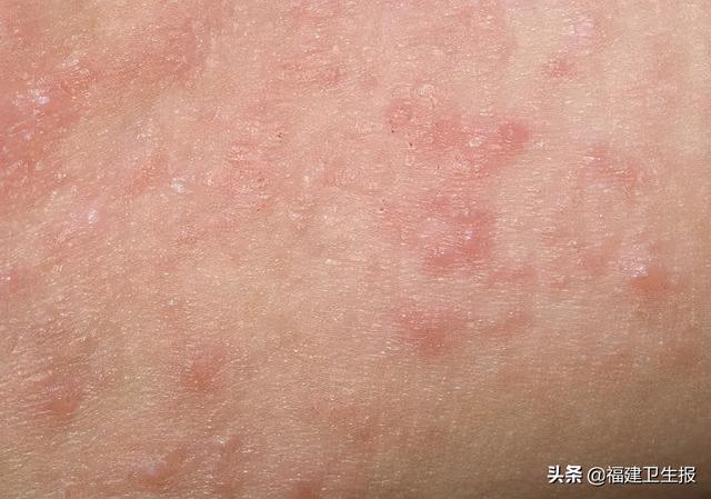 皮疹|福州4岁男童发烧后，身体皮肤摸起来像砂纸！医生紧急提醒：这种病儿童普遍易感，没有疫苗