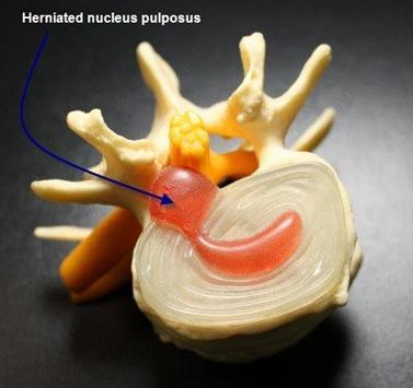椎间盘|腰椎疾病、腰椎间盘突出你想知道的事全集！