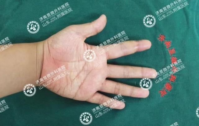 网友提问：失去手指后非常自卑，有没有复原手指的方法？