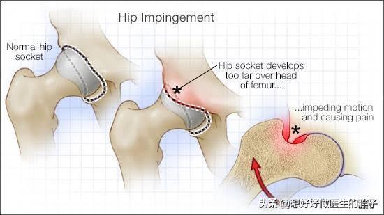 综合症|辟谣I髋关节痛就是滑膜炎？不一定！这种问题很常见却少为人知
