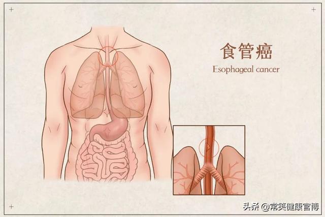 总觉得嗓子眼有东西，咳又咳不出来？医生：赶紧做胃镜