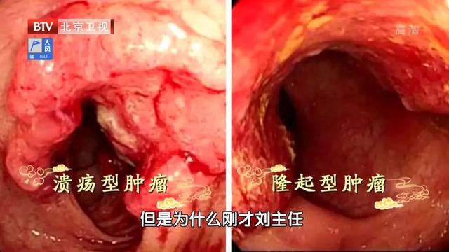 直肠癌|结直肠癌人数连年攀升，却少有人早发现！用对筛查标准，逆转肠癌