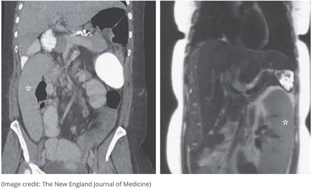 2020年十大怪异医学事件：有人体内长了三颗肾，还有人对冷空气过敏