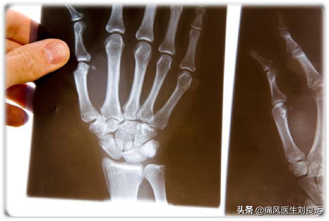 男人易痛风，女人易患类风湿？治疗关节疼痛别“走错门”需对症