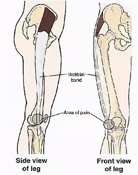 大腿外侧疼痛的几种原因