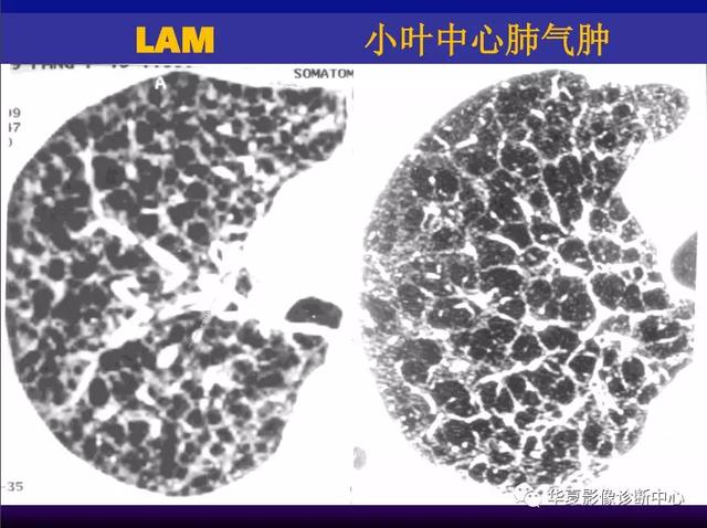 肺间质性疾病的解剖、病理、影像分析