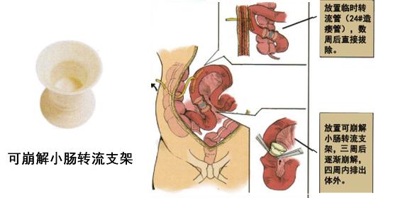 手术|家中“顶梁柱”被查出超低位直肠癌，不愿接受切除肛门，他穿越大半个中国慕名来杭就诊