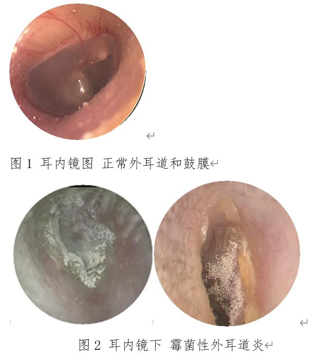 医院|武术教练突然听不见了！专家提醒：不洁掏