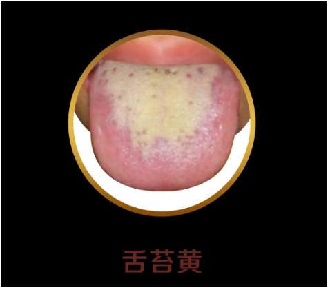 你的育儿经|看舌头，看健康！宝宝这4种常见舌象，都反映什么问题？