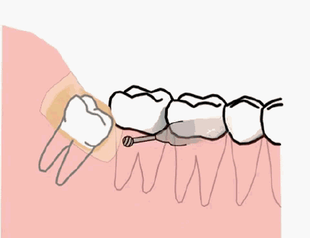 智齿|拔智齿的最佳时期：13~30岁