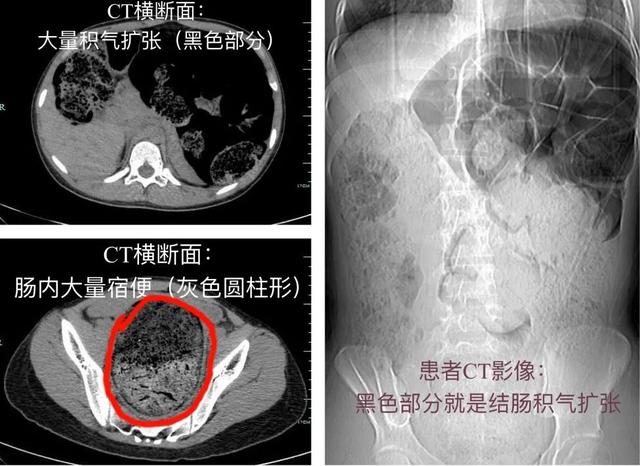 女高中生长期便秘，一查子宫已被挤偏！治疗后一夜轻了8斤...