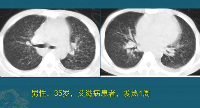 肺结核病人与肥皂的缘分，医生教你用CT片诊断肺结核