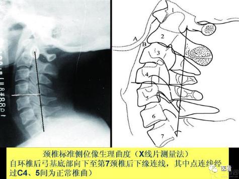 收藏丨手把手教你在X线上如何测量「颈椎生理曲度变直」