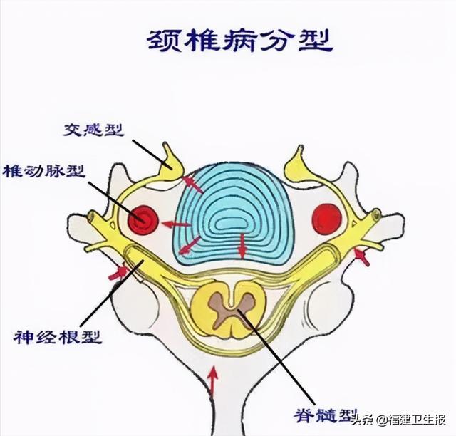 颈椎|一男子莫名头晕失眠、手指发麻……医生一查，病根竟在颈椎上