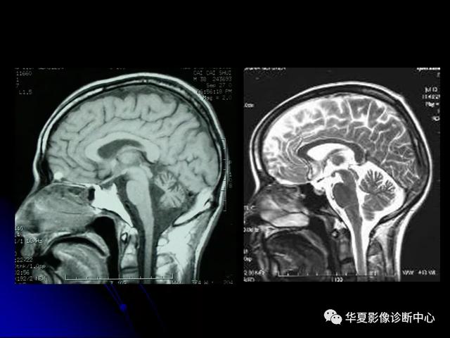 「影像复习」脑干区常见病变影像表现