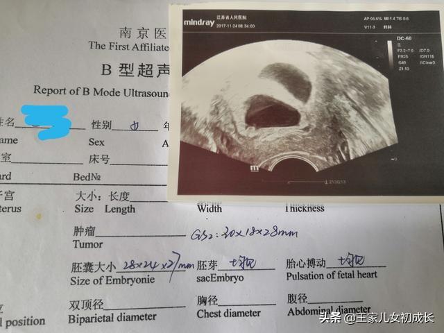 你的育儿经|我的试管之路7—喜极而泣盼来久违的双杠，一超迎来我的双胎宝贝