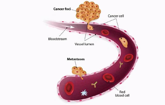癌细胞会转移吗？我想你很有必要应该知道；特别是癌变患者
