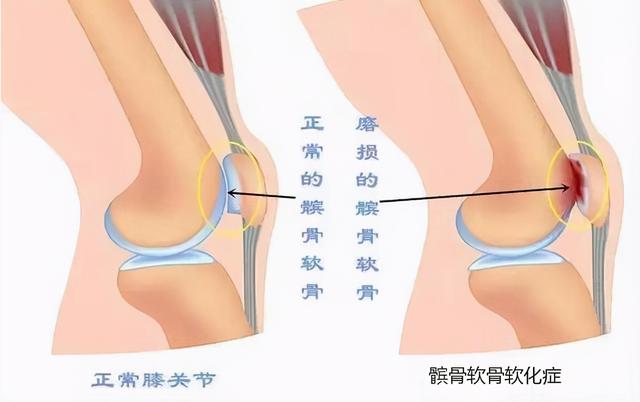 膝盖疼痛原因多，针对性康复治疗最有效