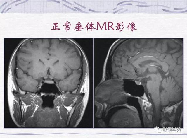 垂体病变的MRI诊断