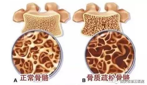 骨质|【世界骨质疏松日】骨质疏松知多少