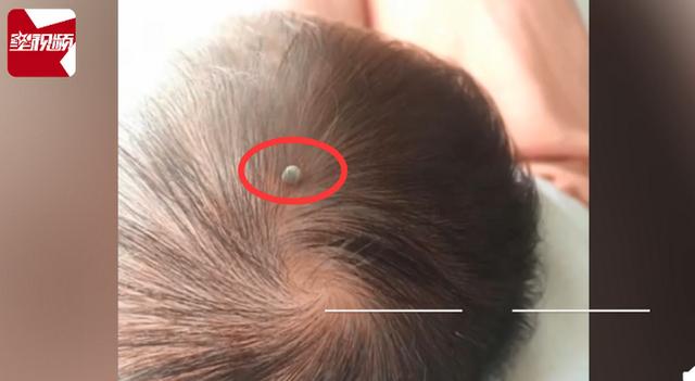 发现|惊险！出生仅4天婴儿被蜱虫咬伤，父亲：发现时头全部吸进去了