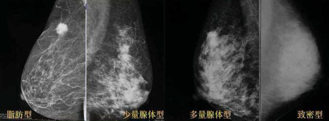 刘佩芳：乳腺X线检查技术和诊断规范