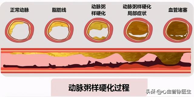 血压的压差大，查查这6个原因，危害大吗？如何避免？