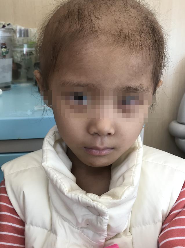 你的育儿经：4岁女儿脸上长了肿瘤，眼睛也出现问题，单亲妈妈急需帮助
