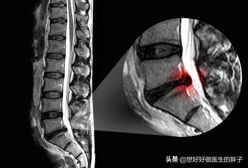 腰间盘|腰间盘突出症患者必须绝对卧床才能好吗？医生：适度活动会更好