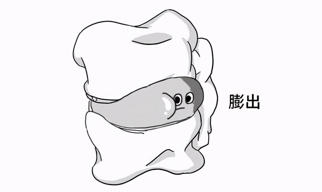 腰椎间盘突出，其实就像婆媳矛盾