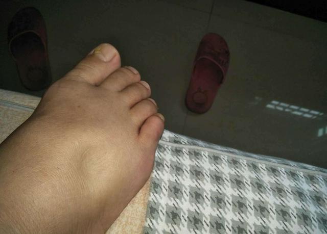 这3大现象是尿毒症的前兆！医生：出现一种也不能忽视，尽早排查