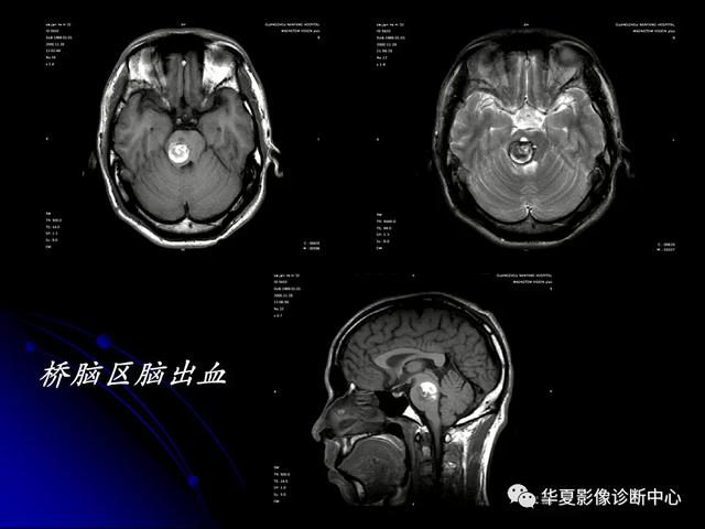 「影像复习」脑干区常见病变影像表现