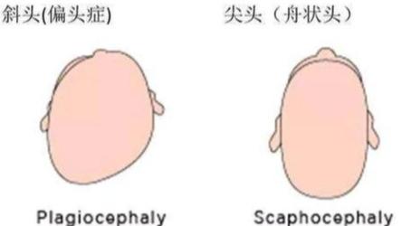 超级宝妈▲“脑勺高,聪明包”,宝宝头型与智商挂钩?家长们别再被误导了