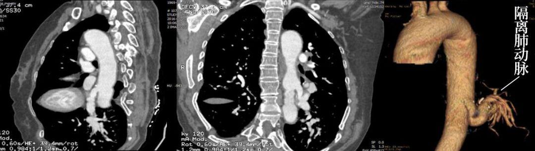 一起来了解肺隔离症 CT 影像表现