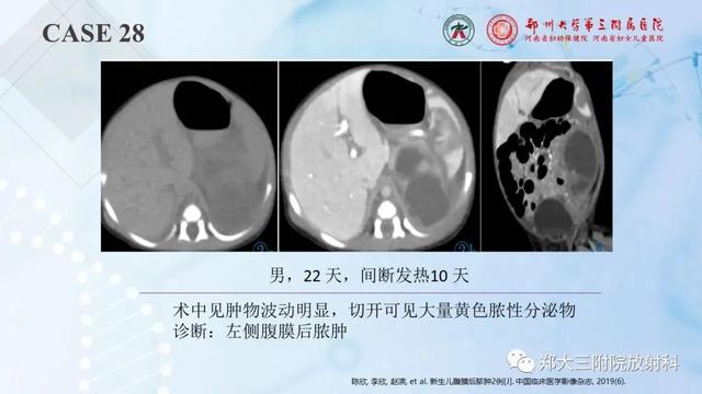 儿童腹部囊性病变诊断思路分析