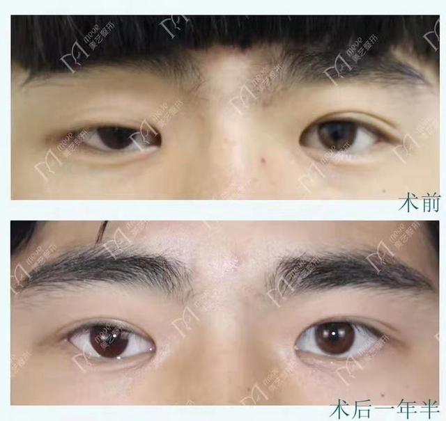 「你的育儿经」刚出生的宝宝发现一个眼大一个眼小咋回事？