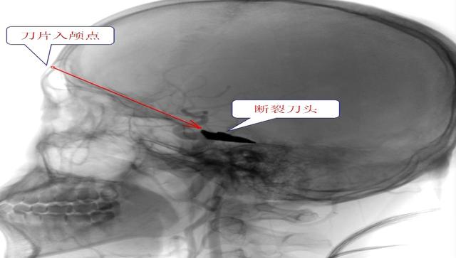 惊！一男子被刀片插入脑内，2周后在沪得救